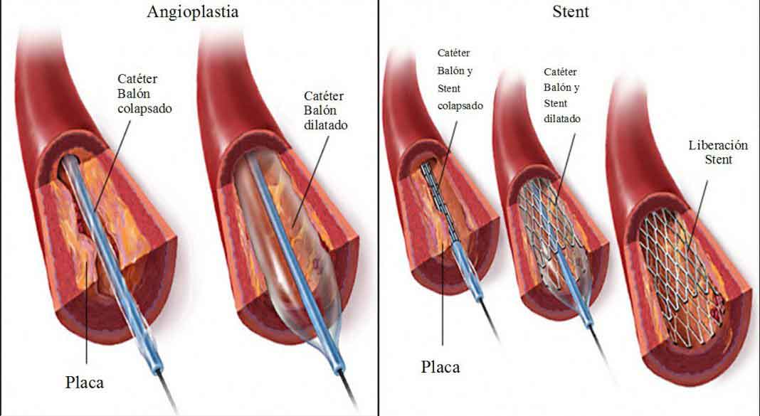 Angioplastia coronaria: Stents