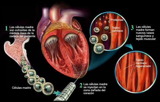Células madre y terapias genéticas para la diabetes mellitus.