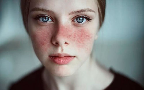 Lupus La Enfermedad Que Padecen 5 Millones De Personas Insights