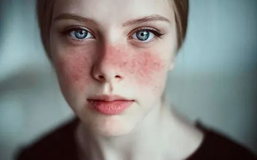 ¿Qué es el lupus?