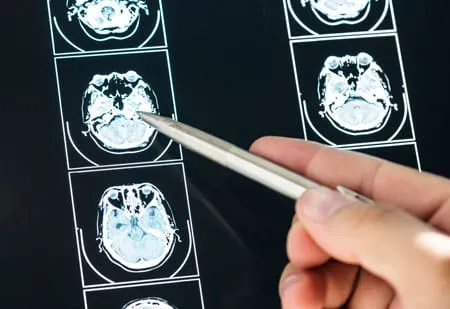 ¿Qué es la parálisis cerebral infantil?