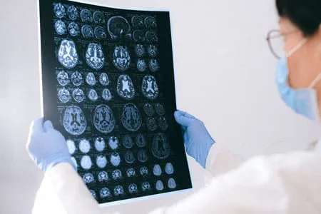 ¿Cómo se trata el Alzheimer?