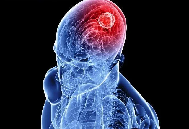 ¿Cuál es la esperanza de vida tras un Ictus?