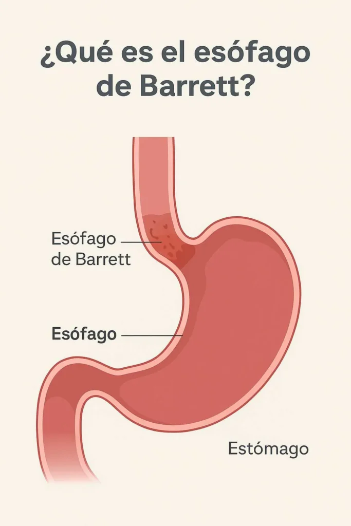 ¿Qué es el esófago de Barrett?