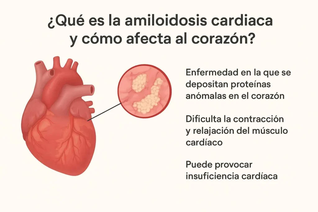 ¿Qué es la amiloidosis cardiaca y cómo afecta al corazón?