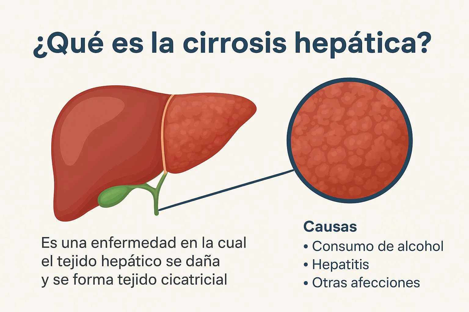 Que es la cirrosis hepática