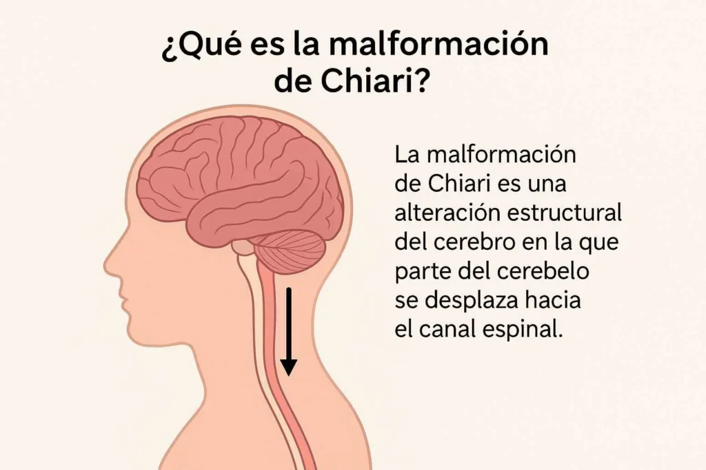 Que es la malformación de Chiari