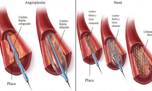 Angioplastia coronaria: Stents