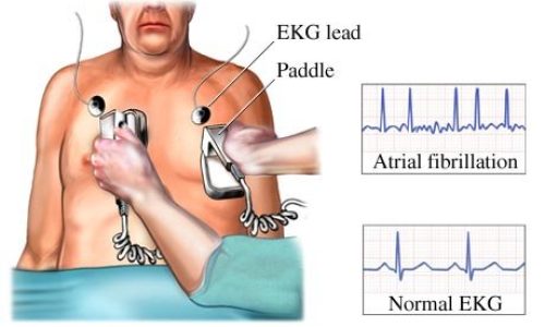 Cardioversión y desfibrilación